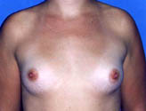 Patient # 43963 Before Photo # 1