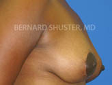 Patient # 24049 After Photo # 4