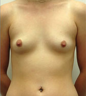 Patient # 95203 Before Photo # 1