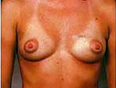 Patient # 42199 Before Photo # 1