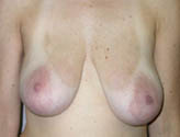 Patient # 16784 Before Photo # 1