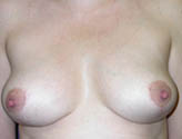 Patient # 53899 After Photo # 2