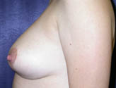 Patient # 53899 After Photo # 4