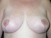 Patient # 79197 After Photo # 2