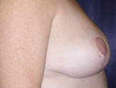 Patient # 79197 After Photo # 6