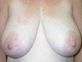 Patient # 79197 Before Photo # 1