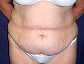 Patient # 69263 Before Photo # 1