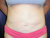 Patient # 87998 After Photo # 2