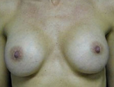 Patient # 77525 After Photo # 2