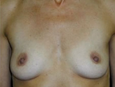 Patient # 77525 Before Photo # 1