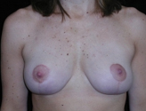 Patient # 50732 After Photo # 2