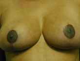 Patient # 29940 After Photo # 2