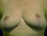 Patient # 56990 After Photo # 2