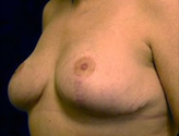 Patient # 56990 After Photo # 4