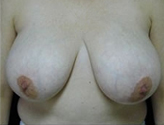 Patient # 56990 Before Photo # 1