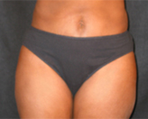 Patient # 14238 After Photo # 2