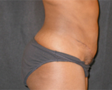 Patient # 14238 After Photo # 4