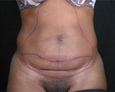 Patient # 14238 Before Photo # 1