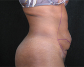 Patient # 14238 Before Photo # 3