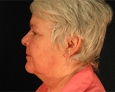 Patient # 18865 Before Photo # 5