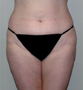 Patient # 26693 After Photo # 2