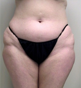 Patient # 26693 Before Photo # 1