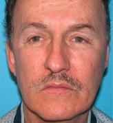 Patient # 69128 After Photo # 2