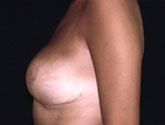 Patient # 11165 After Photo # 2