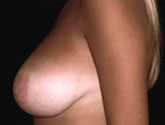 Patient # 11165 Before Photo # 1