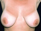Patient # 23380 Before Photo # 1