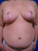 Patient # 48401 After Photo # 4