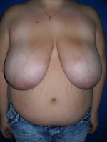 Patient # 48401 Before Photo # 3