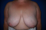 Patient # 48401 Before Photo # 5