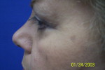 Patient # 41248 After Photo # 2