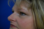 Patient # 41248 After Photo # 4
