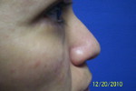 Patient # 41248 After Photo # 6