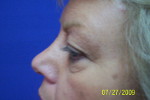 Patient # 41248 Before Photo # 1