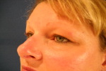Patient # 41248 Before Photo # 3
