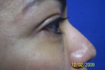 Patient # 41248 Before Photo # 5