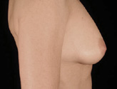 Patient # 66940 Before Photo # 3