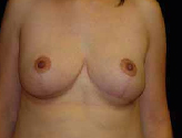Patient # 49684 After Photo # 2