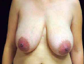 Patient # 49684 Before Photo # 1