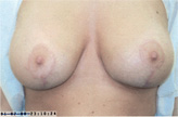 Patient # 61480 After Photo # 2