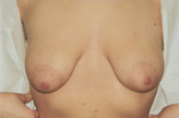 Patient # 61480 Before Photo # 1