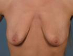Patient # 94463 Before Photo # 1