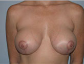 Patient # 66502 After Photo # 2
