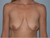 Patient # 66502 Before Photo # 1