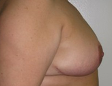 Patient # 99954 After Photo # 6