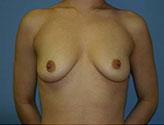 Patient # 69514 Before Photo # 1