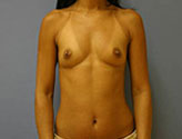 Patient # 71435 Before Photo # 1